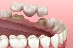 Crowns and Bridges in Ulhasnagar