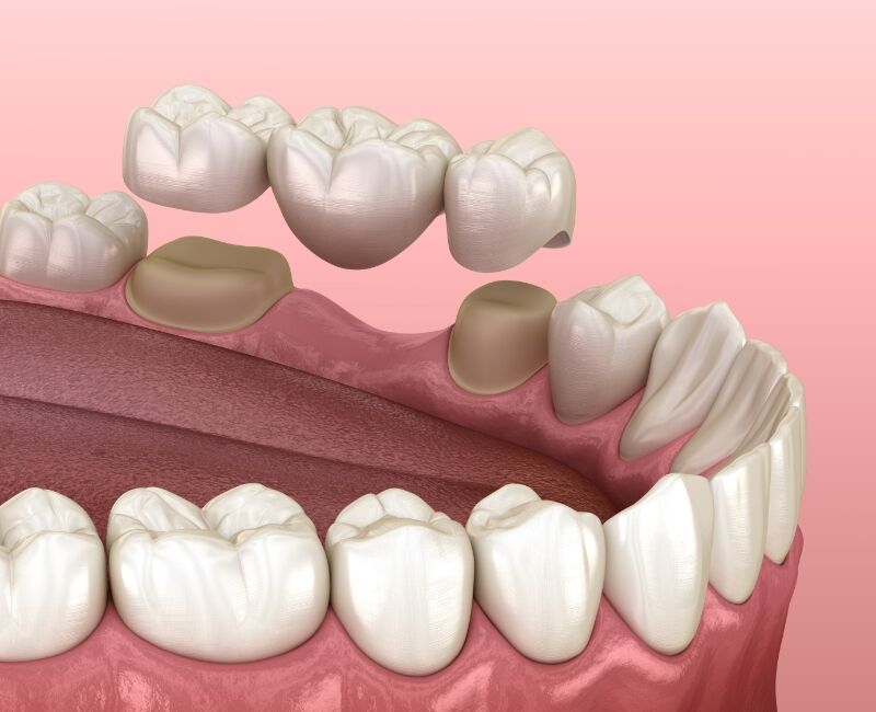 Crowns and Bridges in Ulhasnagar